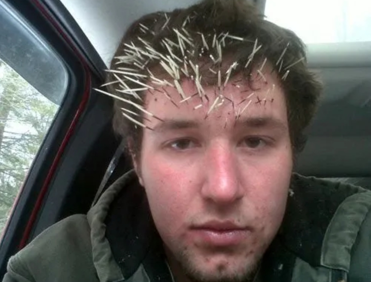 man with porcupine quills stuck in forehead