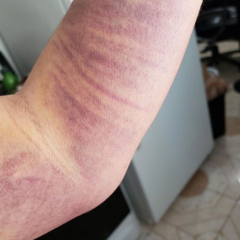 Woman with purple arm