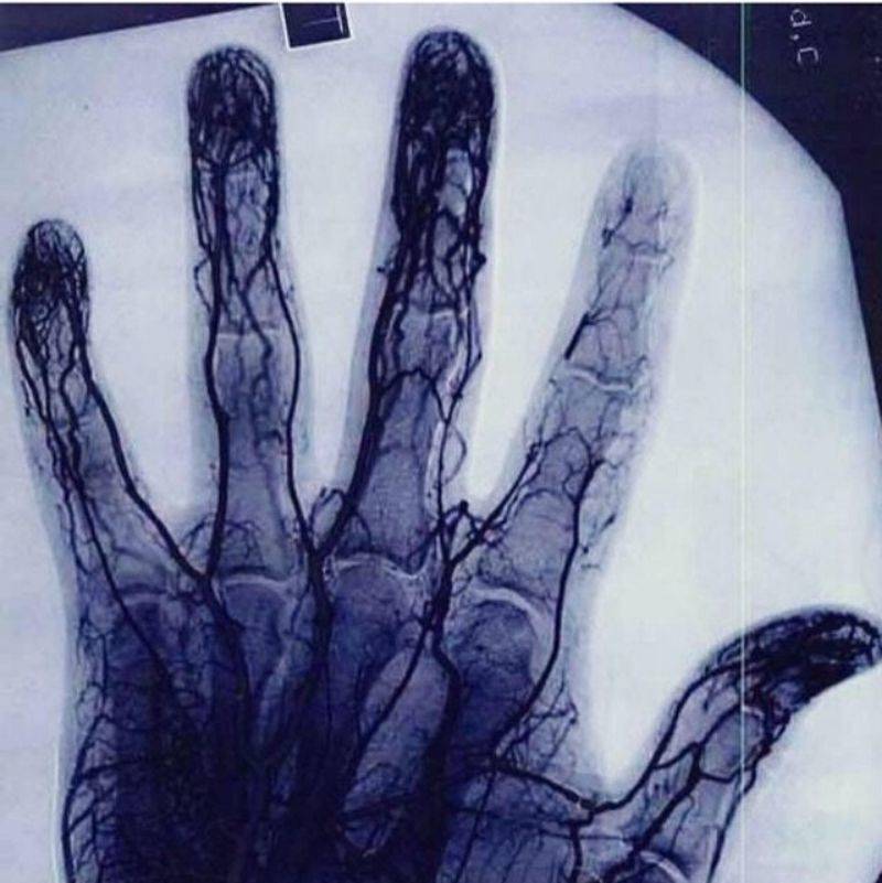 an x ray of a yoyo players hand