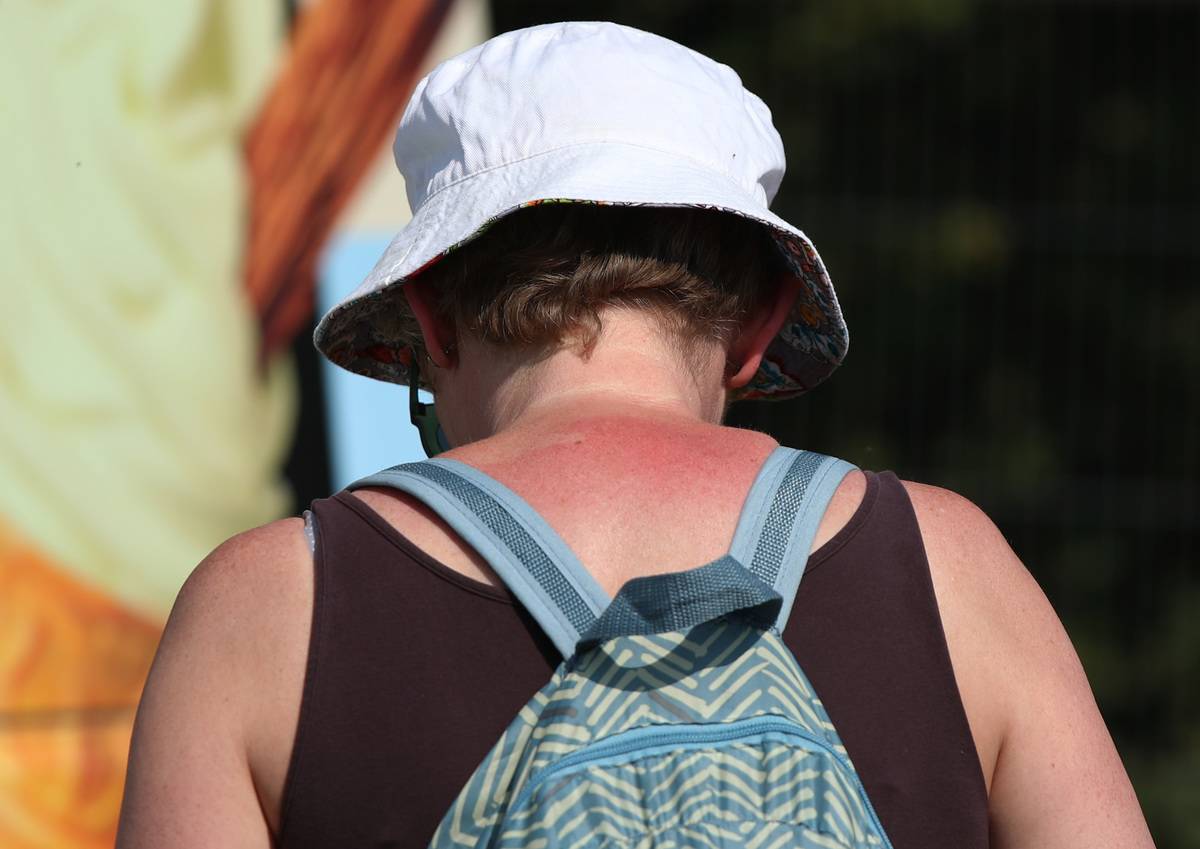 A woman with a sunburn on the back of her neck walks around outside.