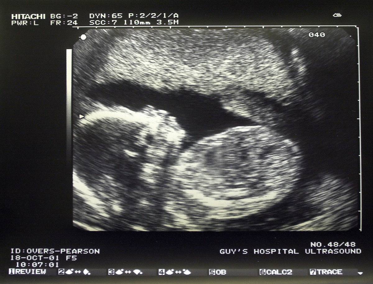 A pre-natal ultrasound showing a baby in the mothers womb