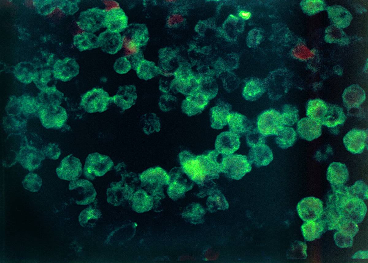 amebic meningoencephalitis due to Naegleria fowleri parasites
