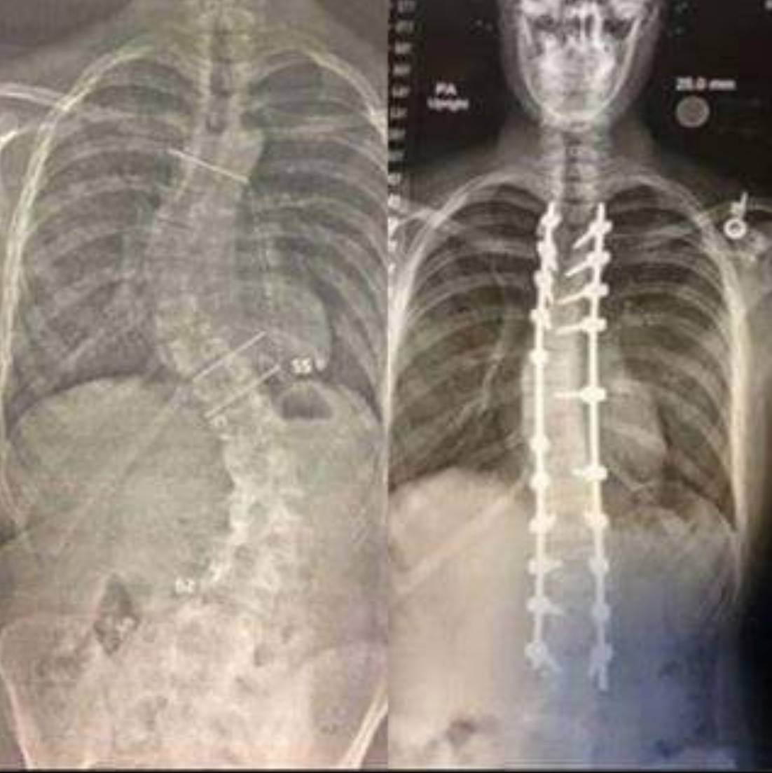 x-rays show before (crooked spine) and after (spine straighter with rods)