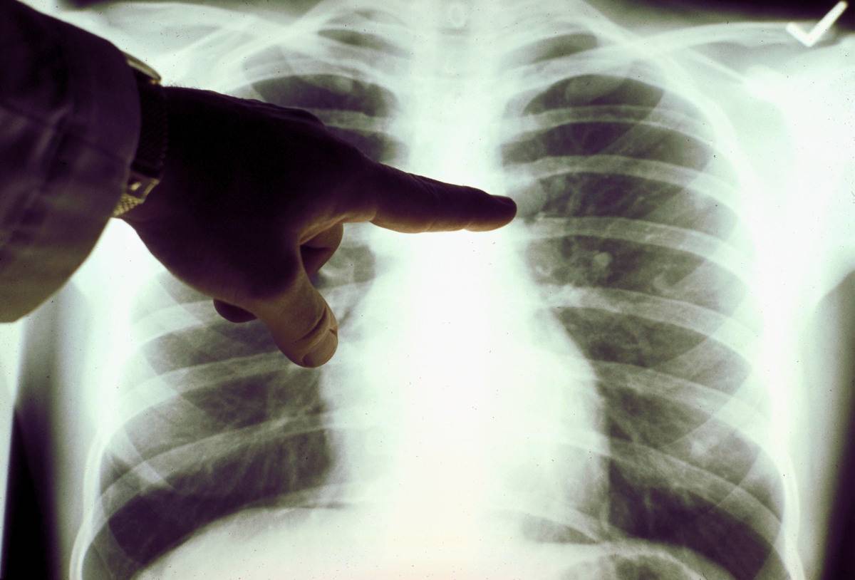 A view of a close up of a lung x-ray