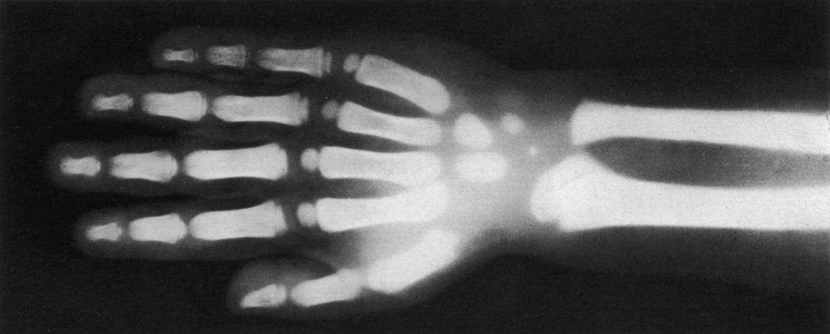 X-Ray view of the hand and wrist of a four year-old child, showing the bone structure of the arm and fingers.