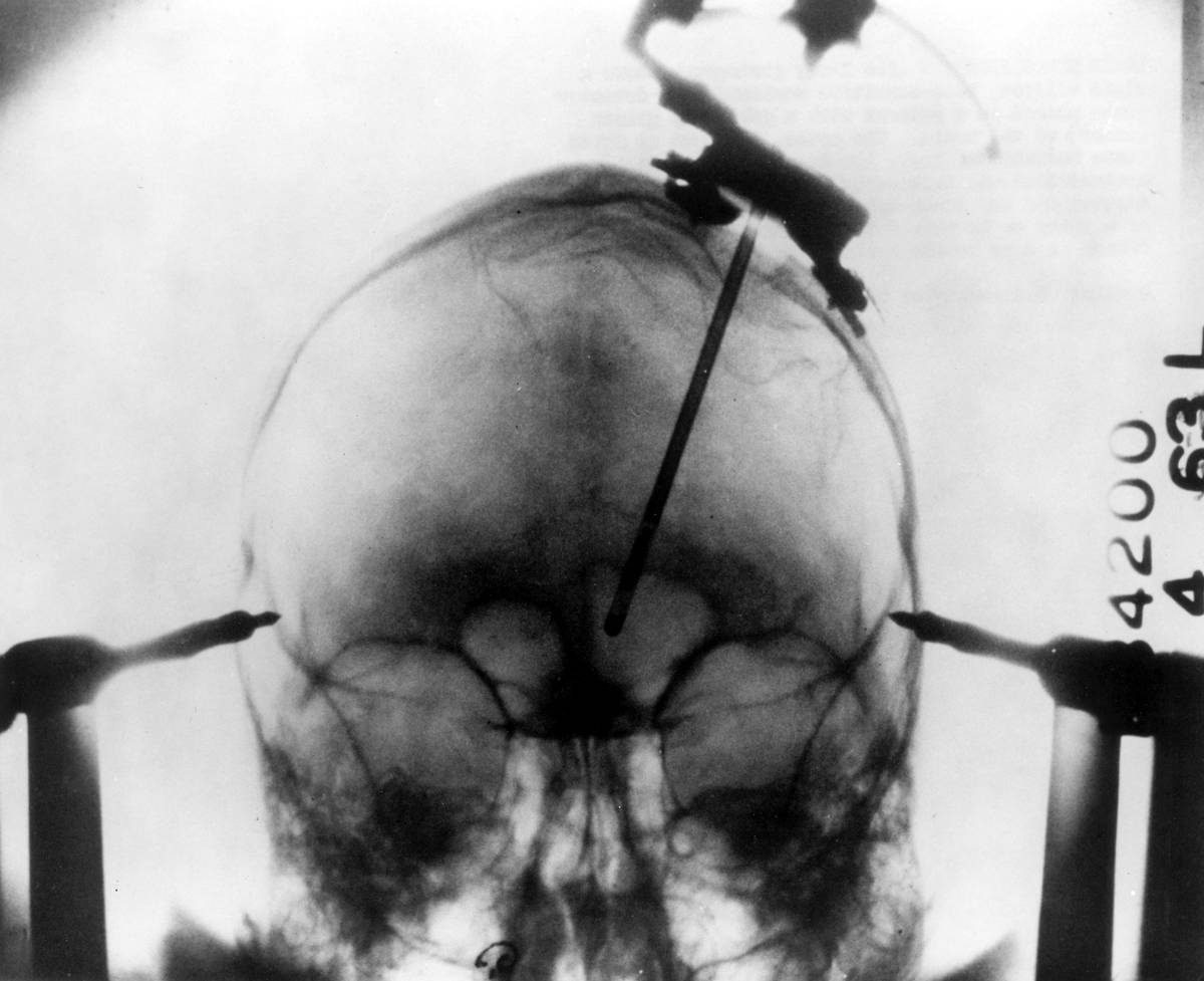 An X-ray photograph that shows a detector probe placed in a patient with a brain tumor