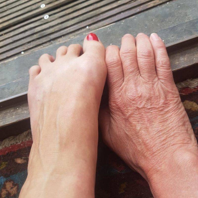 the skin damage between a person's hand and foot