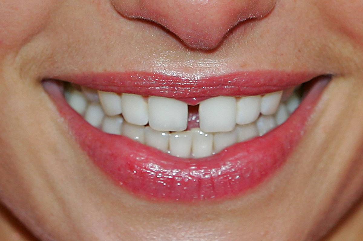 The teeth of Supermodel Jess Hart are seen as she smiles