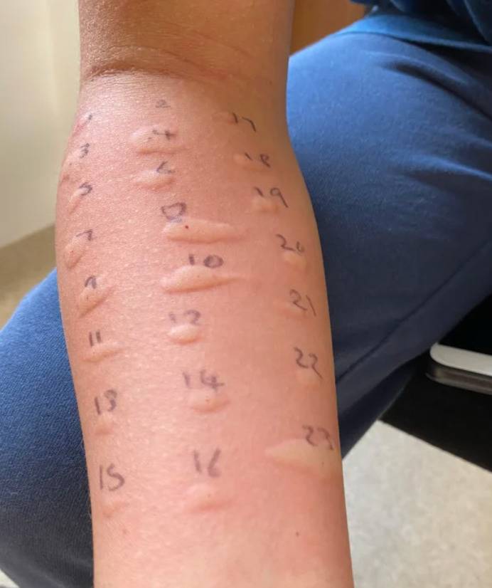 person with all spots on their arm swollen from allergy test