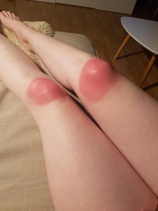 burned knees on legs