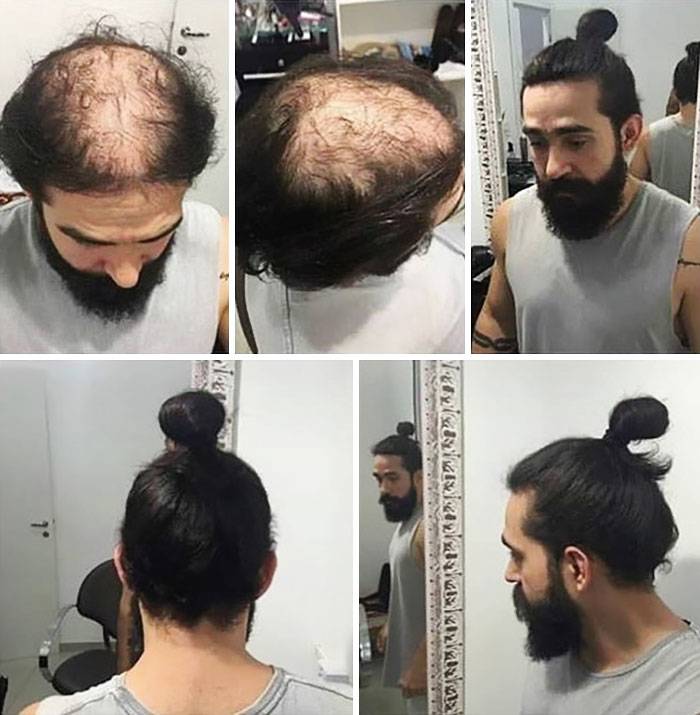 man hiding bald spots using man bun
