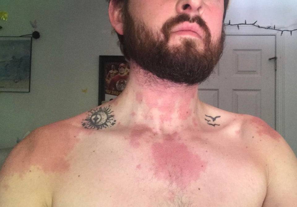 Bearded man from the nose down - with a rash all over his chest and neck