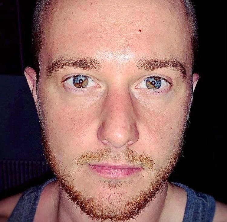man with heterochromia