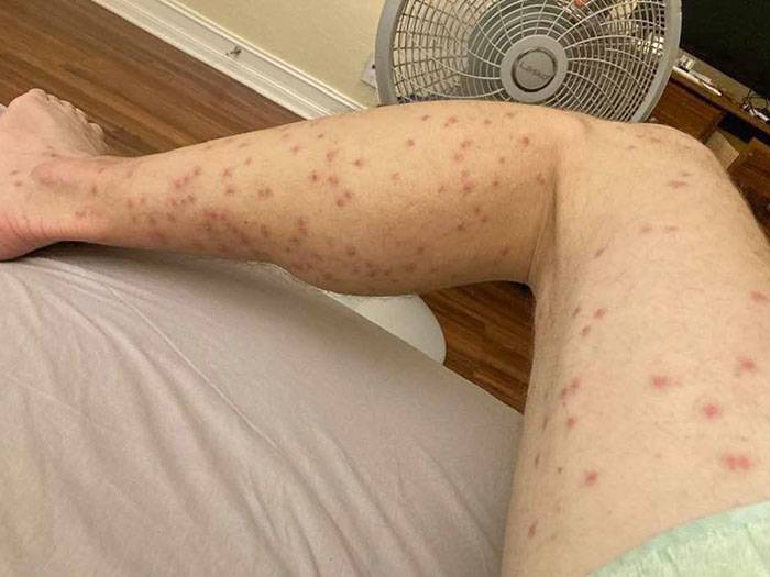 person's leg covered in dozens of bug bites