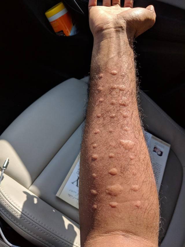 Man's arm with 26+ welts from local allergen prick test