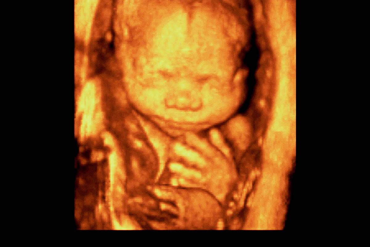 Surface Mode Of The Fetal Face And The Left Hand. Fetus At 24 Weeks