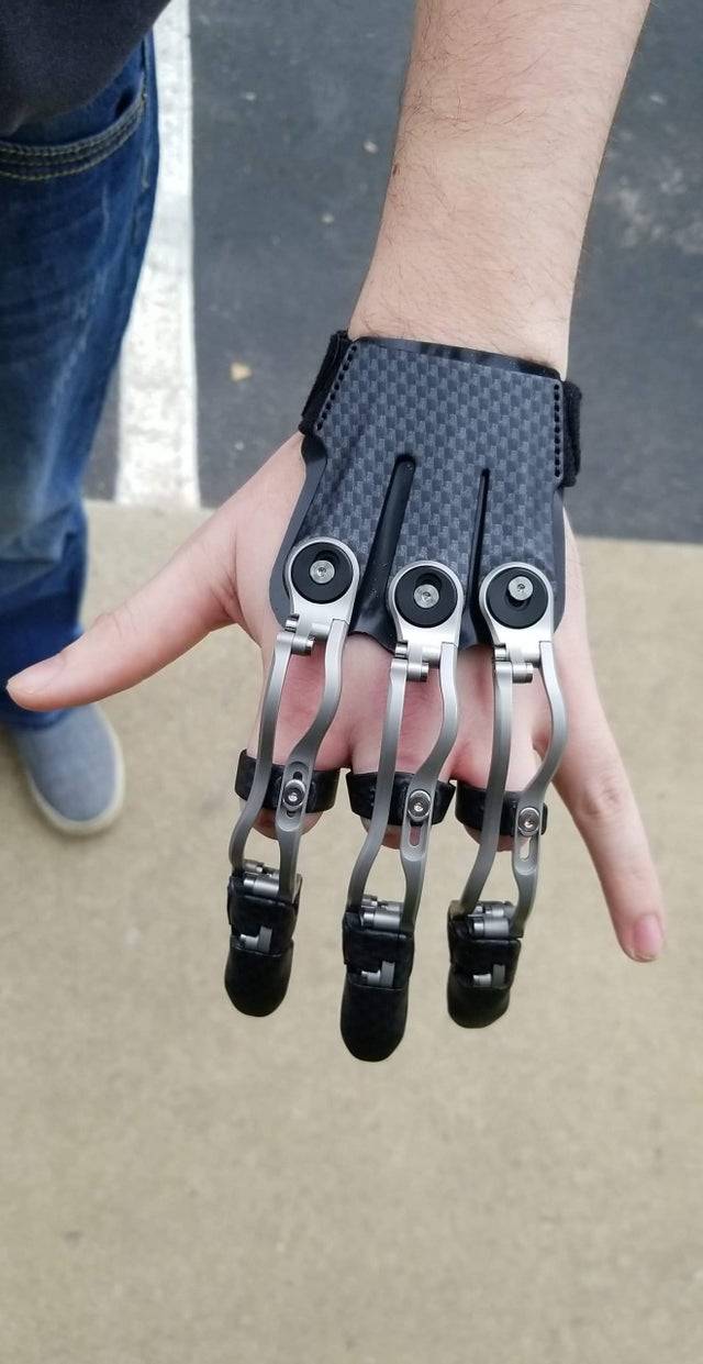 Hand missing three fingers has a robotic prosthetic fingers on