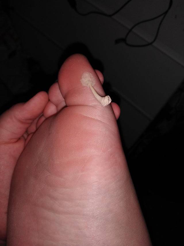 shark tooth stabbed foot