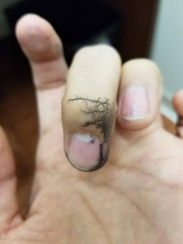 marks on the skin from ink