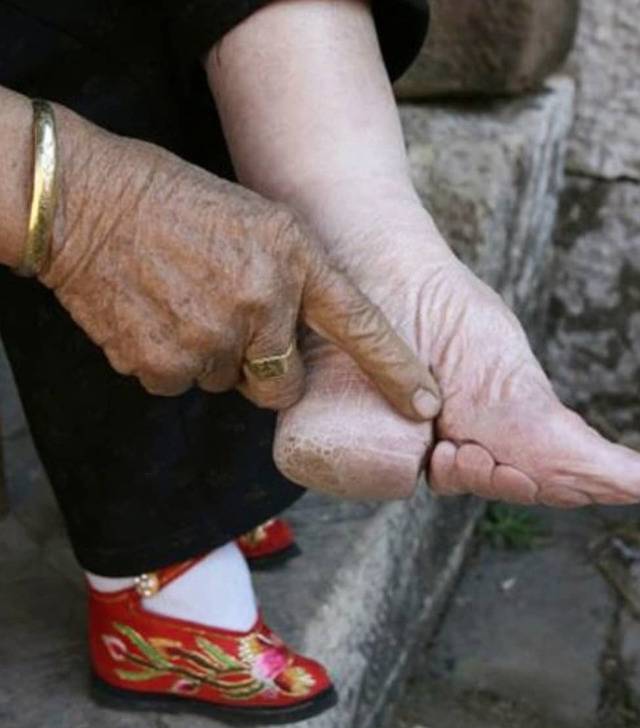 Woman's foot that has been foot-bound. 