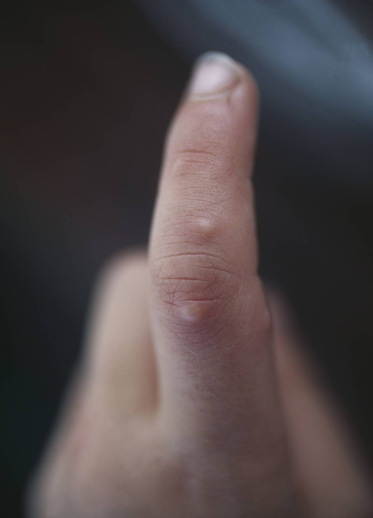A close-up of a finger with multiple mosquito bites on it.