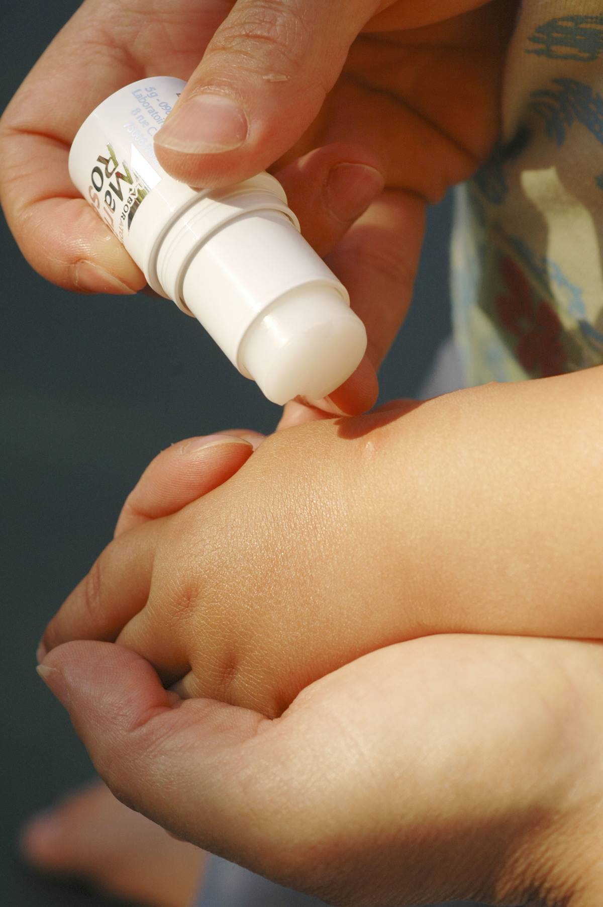 Medication is applied to a 14-month-old boy to treat mosquito bites.