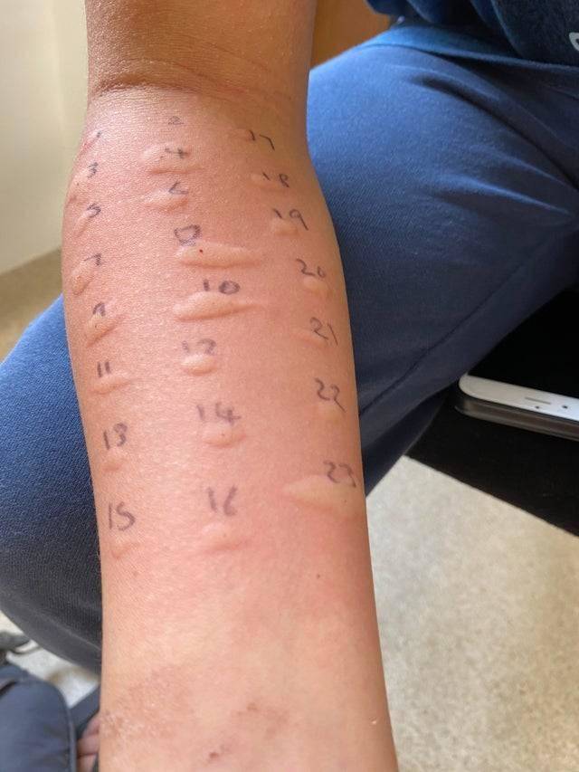 someone who was allergic to everything they were tested for