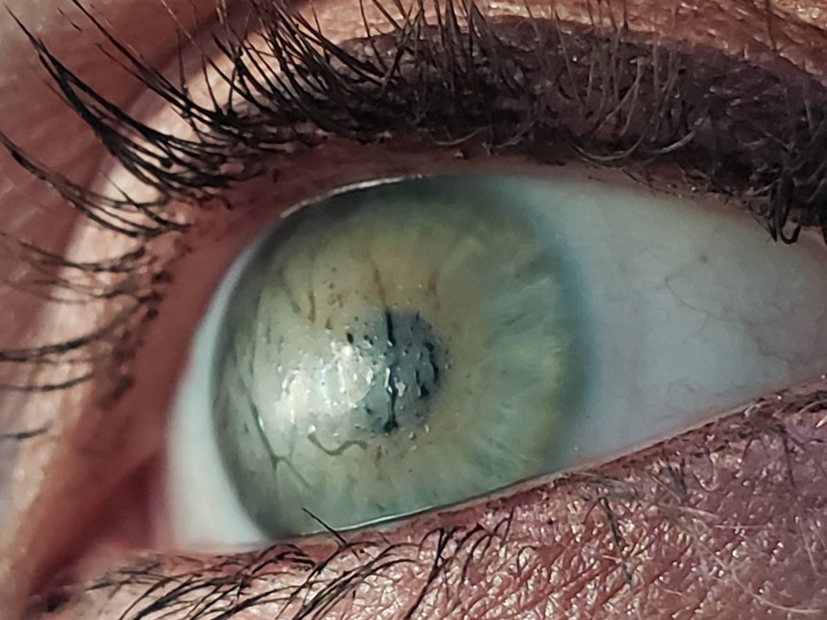 contact fog in woman's eye