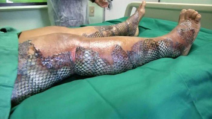 fish graft on burn