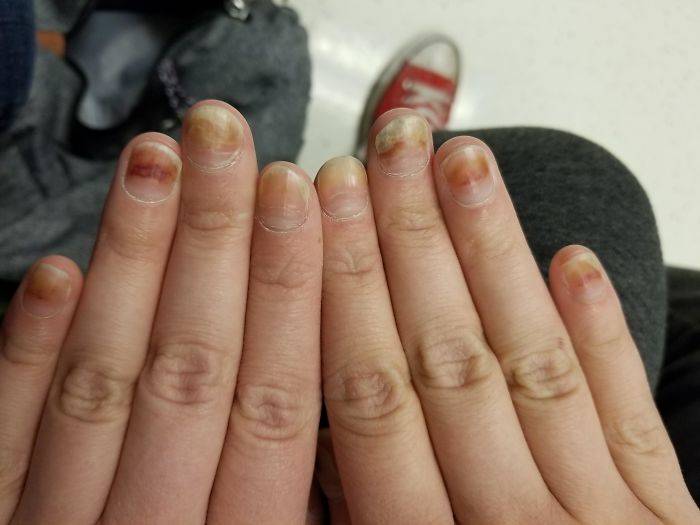 nails pushing chemo out