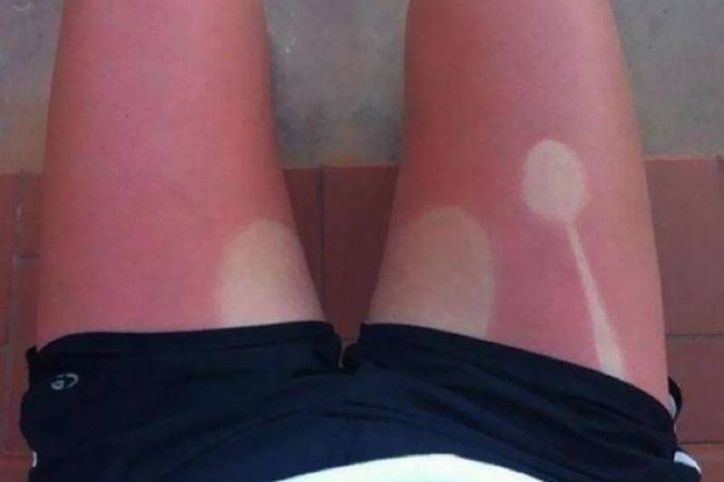 funny-sunburned-people-43-5f27d5ce7cedf__700-35827