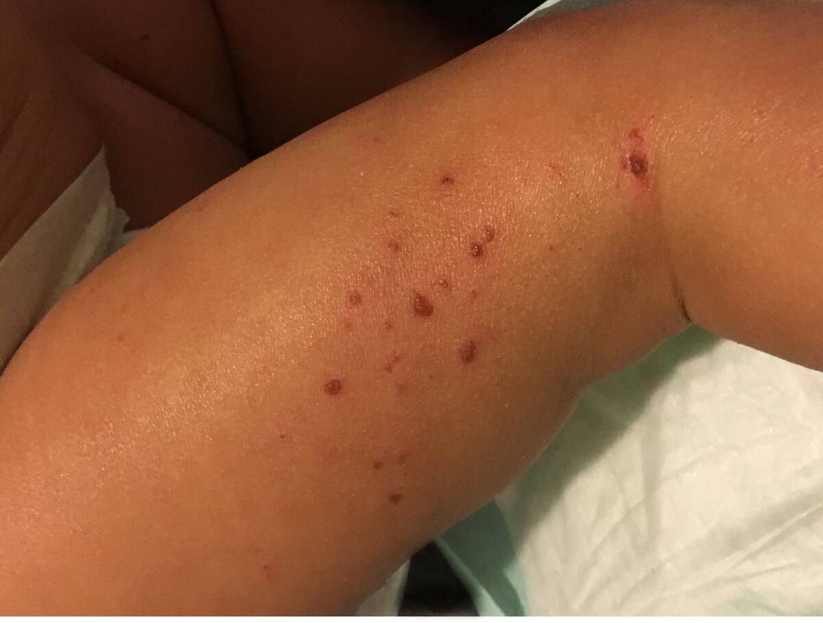 Child with eczema