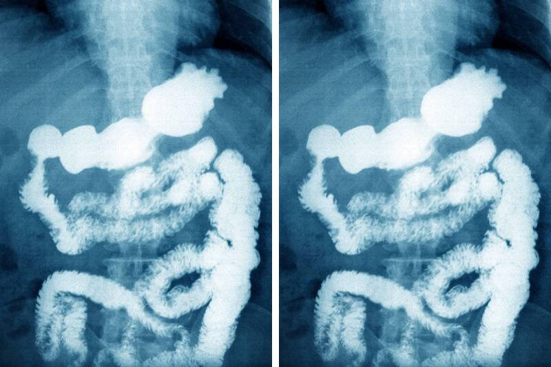 colon x-ray