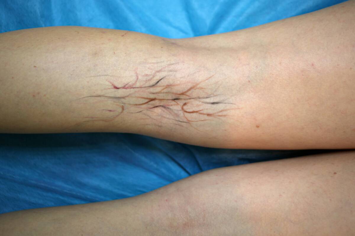 Makeup imitating varicose veins is on the lower limb of an...