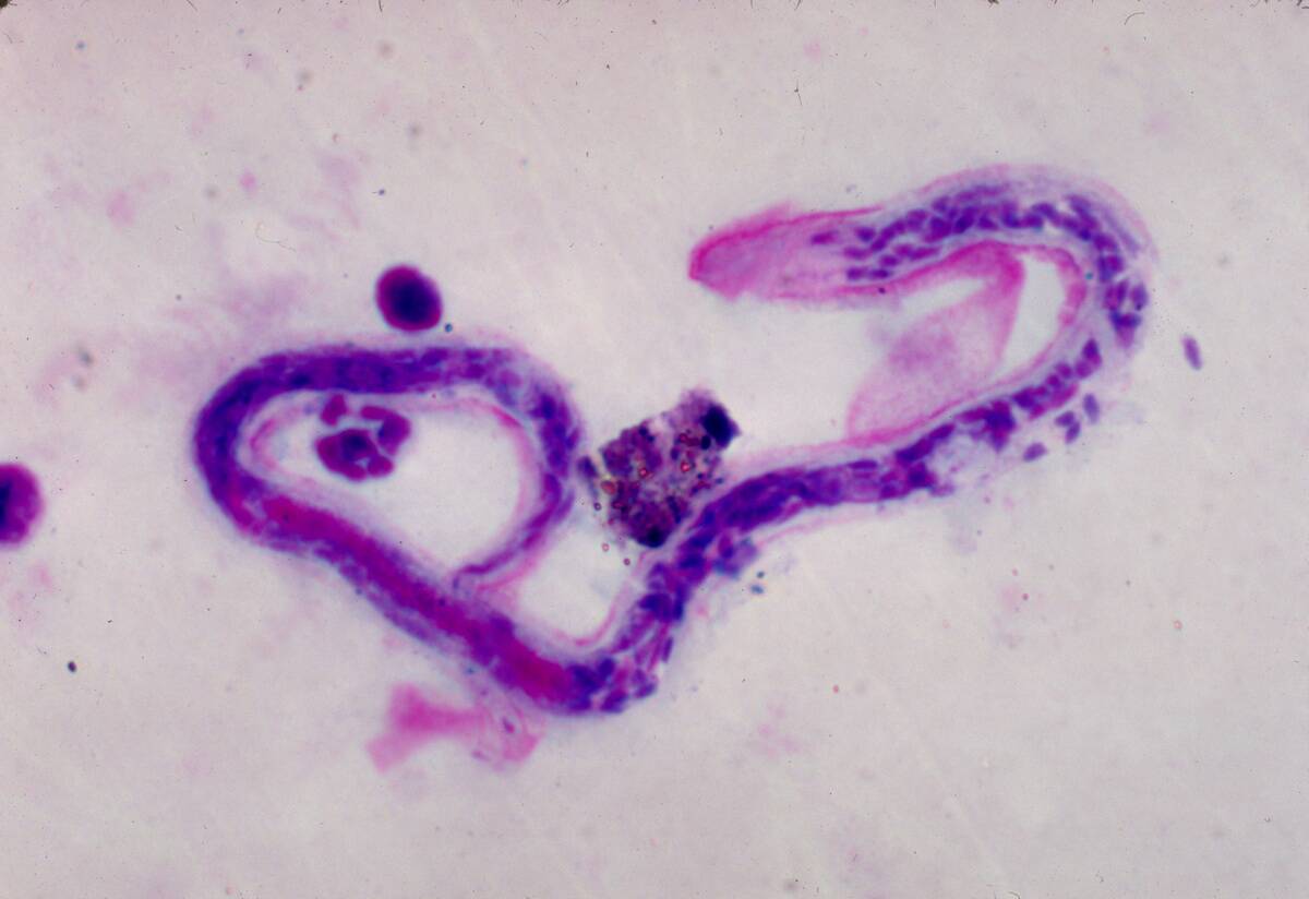 Brugia Malayi