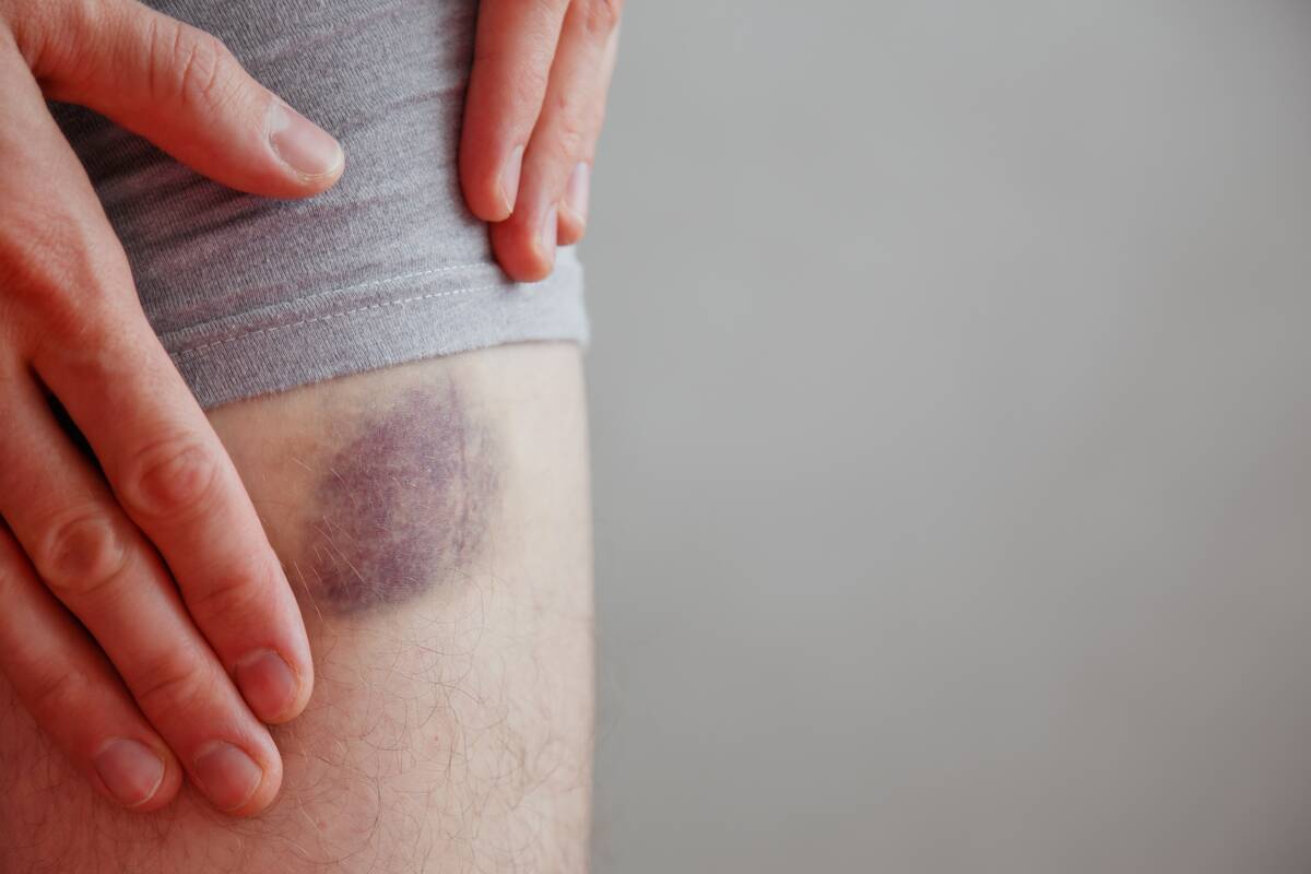 bruise-on-leg-injection-bruises-bruised-wound-in-2023-11-27-05-30-05-utc