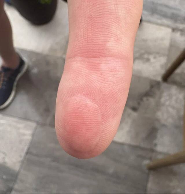 uncle-severed-the-pad-off-his-index-finger-doctor-sutured-v0-2018kk4rloif1