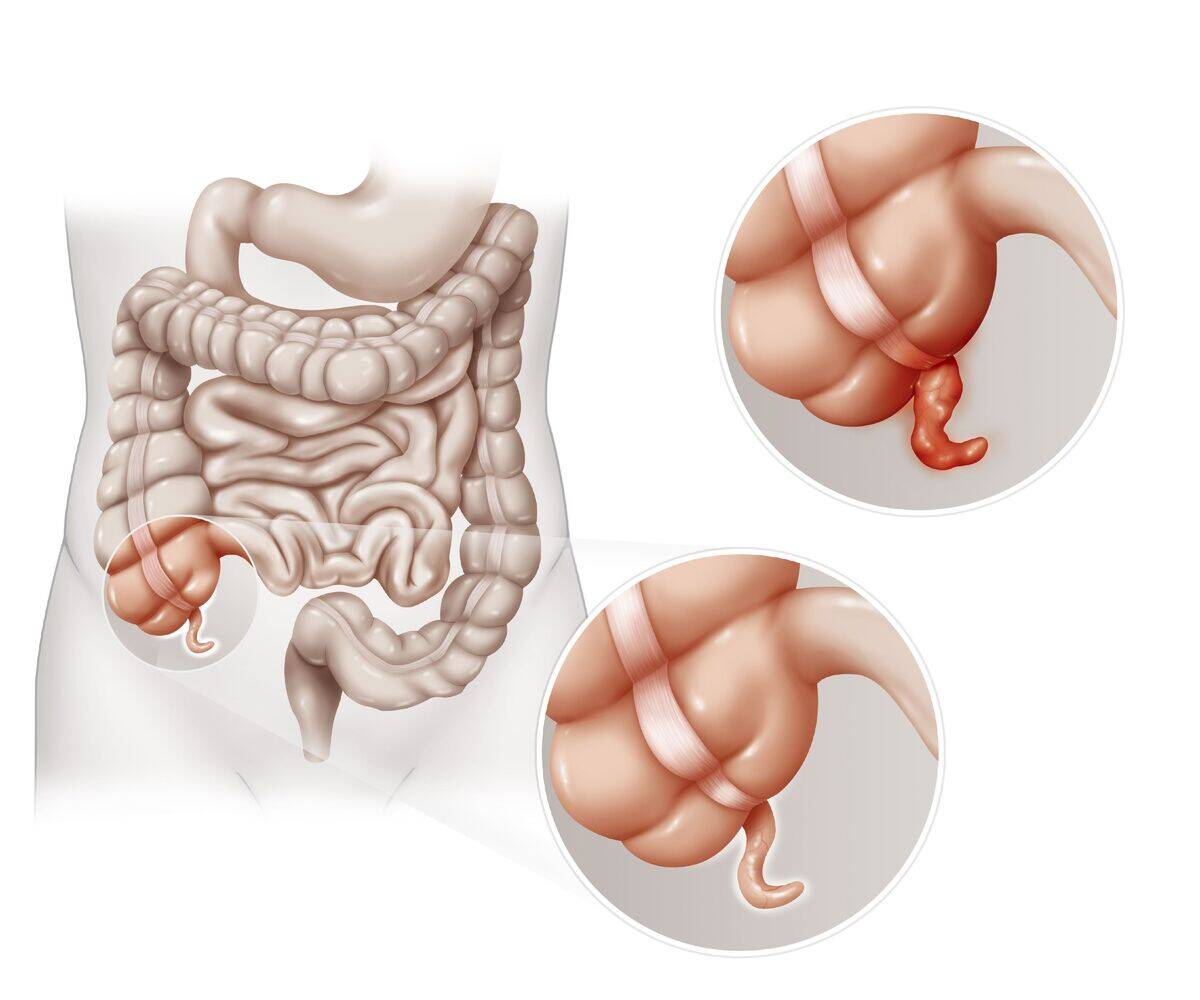 Appendicitis, drawing