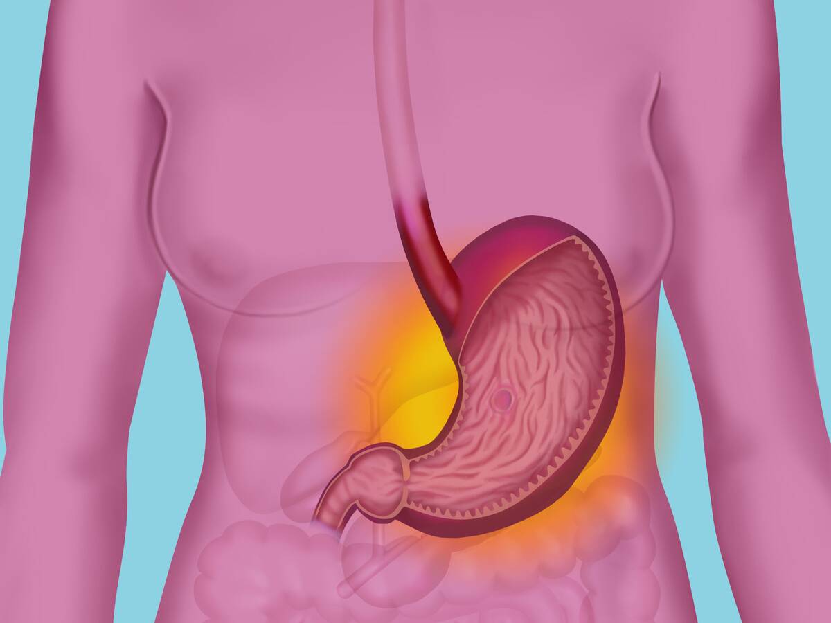 Gastric Ulcer, Drawing