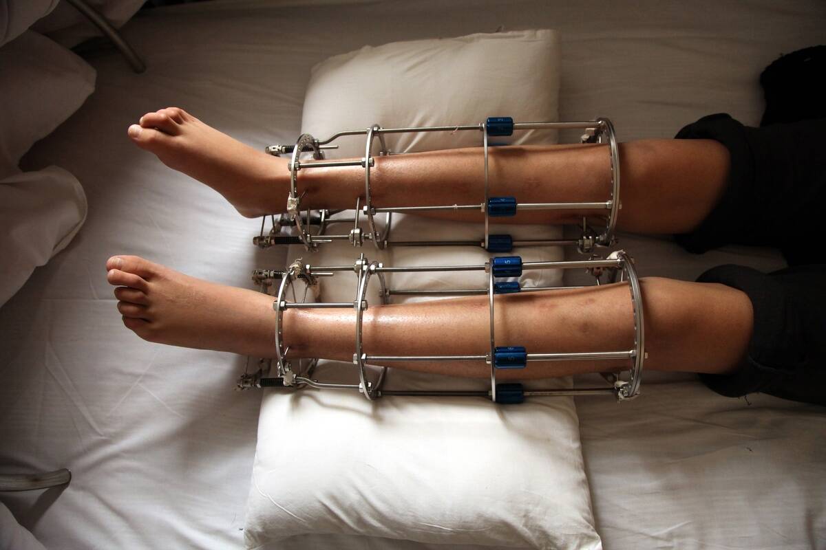 Legs Lenghtening Hospital in Beijing