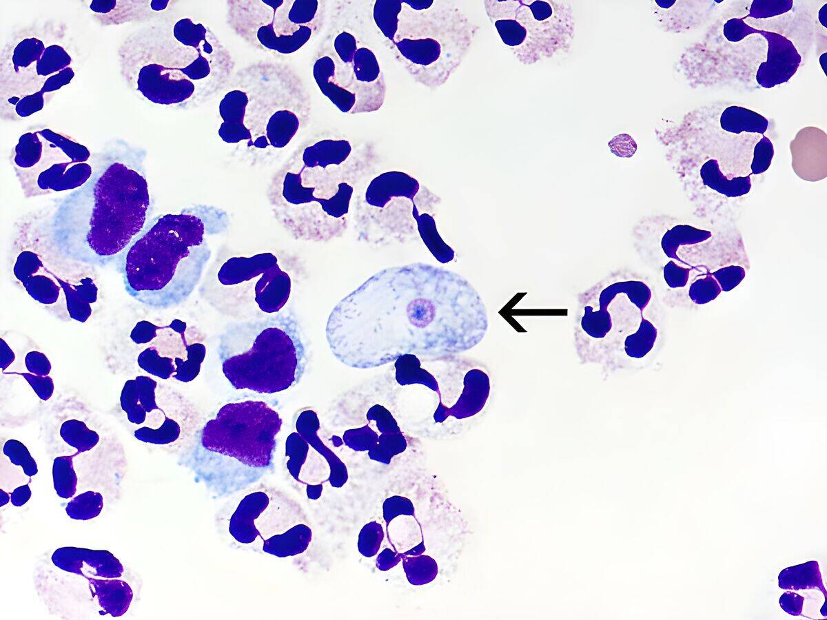 Naegleria fowleri