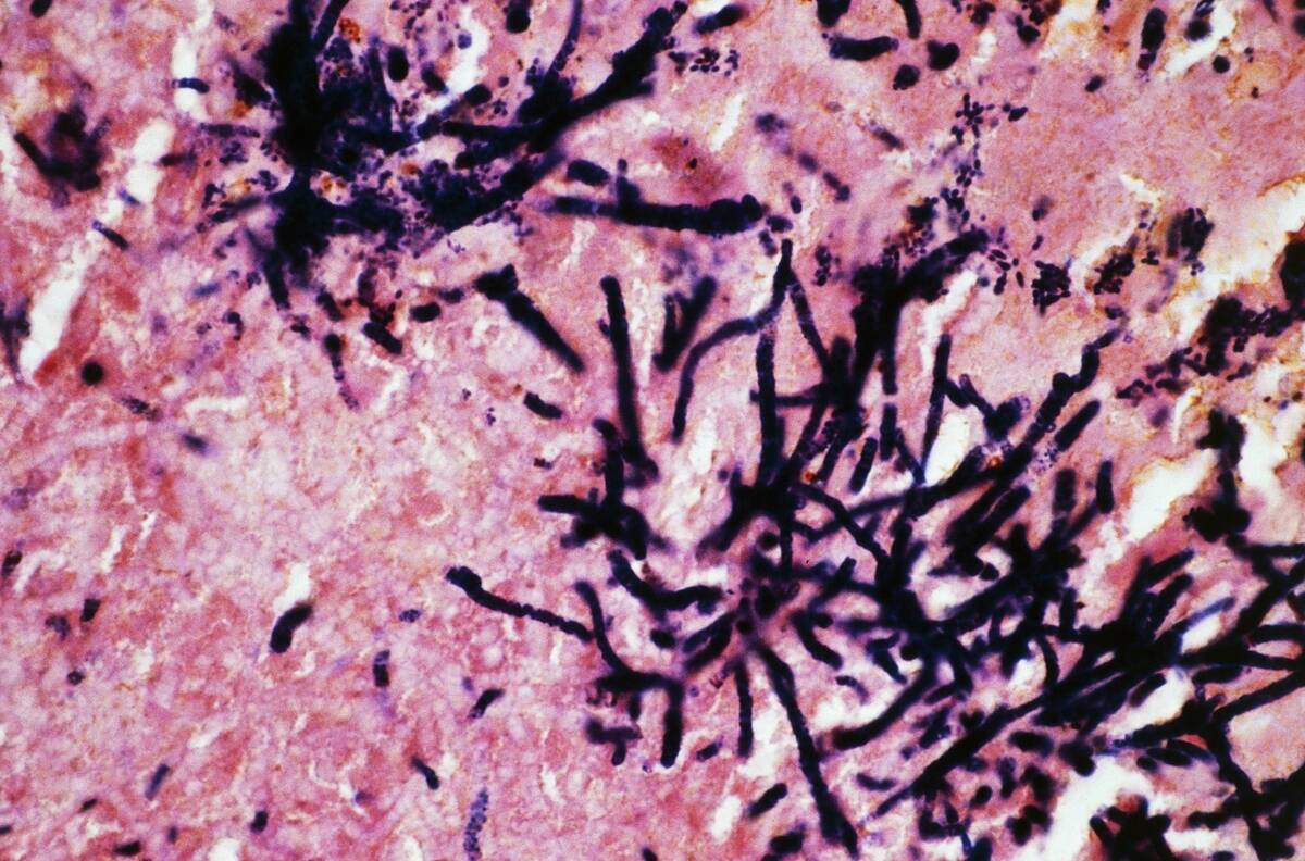 Tonsil with gram-positive bacteria...