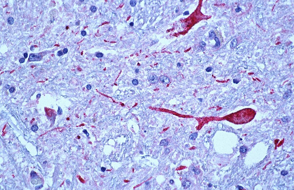 West Nile encephalitis