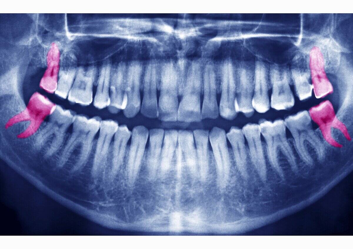 Wisdom Tooth, X Ray