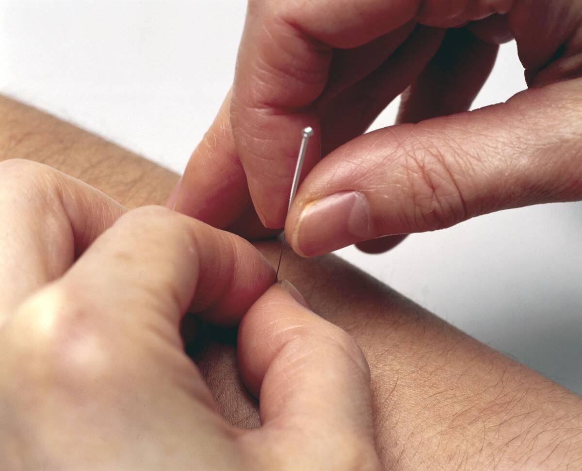 Demonstrating acupuncture, 2000.