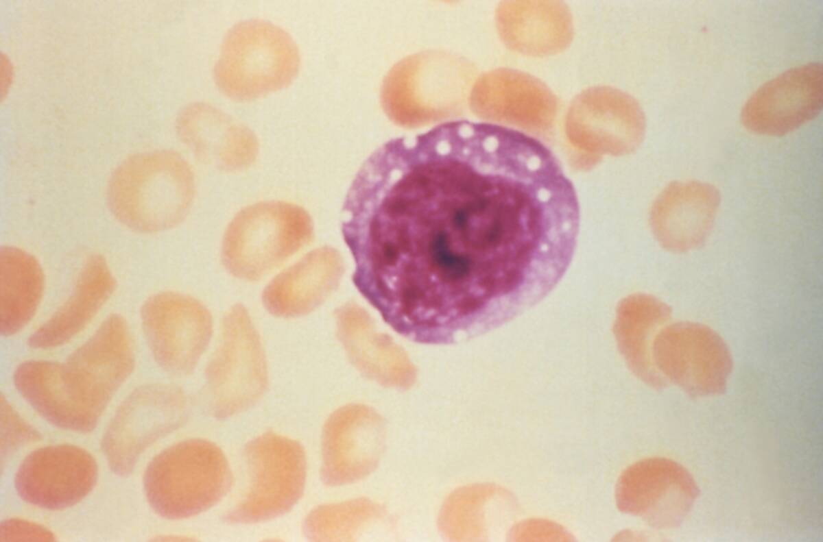 Enlarged Lymphocyte